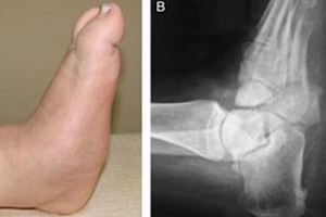 Muskuloskelettales Modell Charcot-Fuß